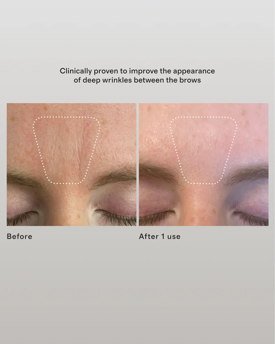 Wrinkle Erasing Retinol Patches by 111SKIN - One Size / No Color